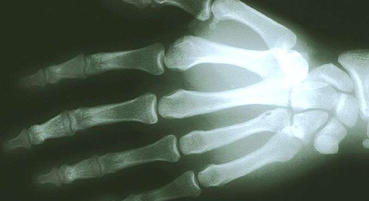 X-ray errors